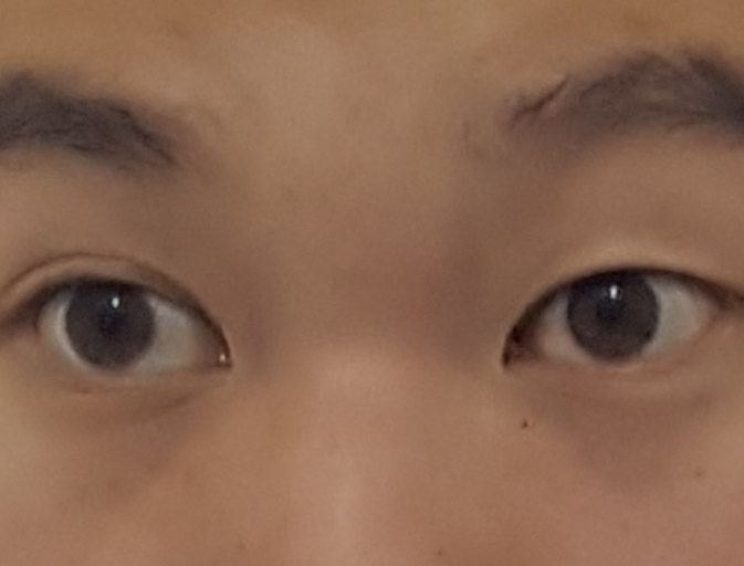 一觉睡醒之后单眼皮变双眼皮是一种怎样的体验?