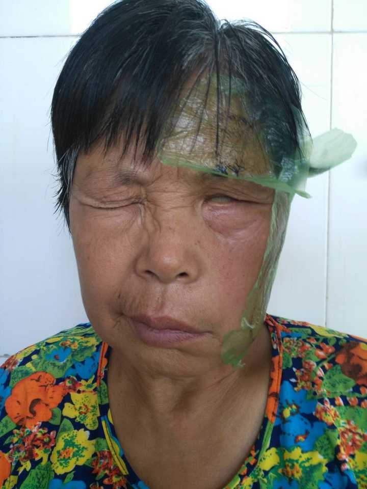 面瘫恢复的比较慢有啥好办法吗?