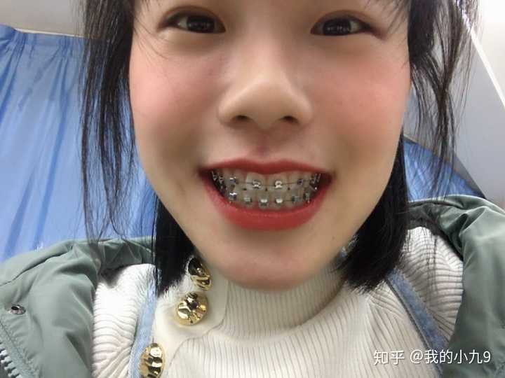 戴牙套一般要多久 知乎