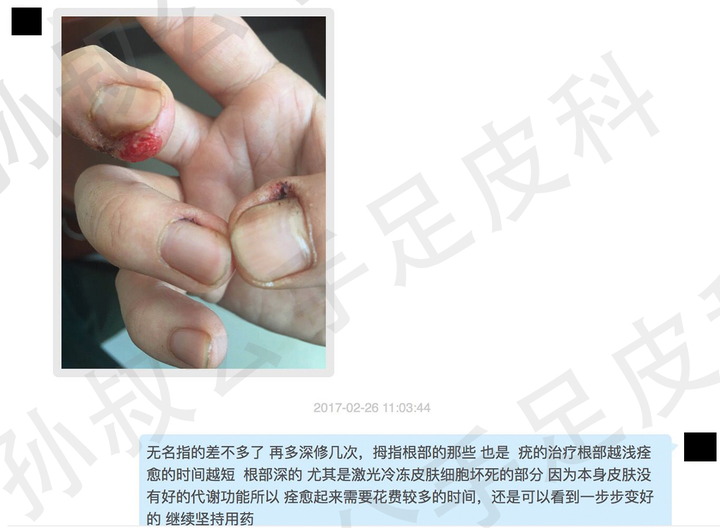 困扰了很多年的甲周疣,在右手的中指上,疣体已经占据了指甲的一半.