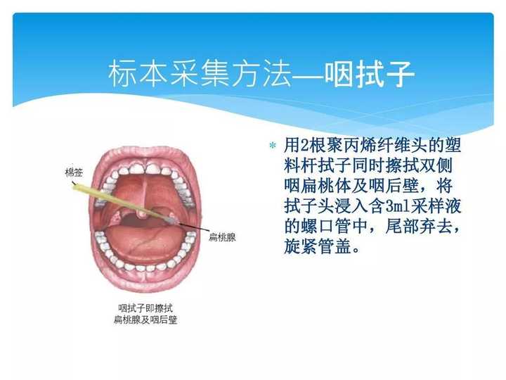 咽拭子采集样本的方法(图源:slidesplayer.com)