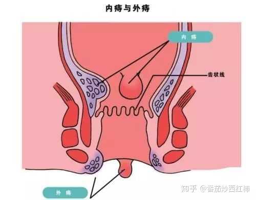 有痔疮是一种什么样的体验?