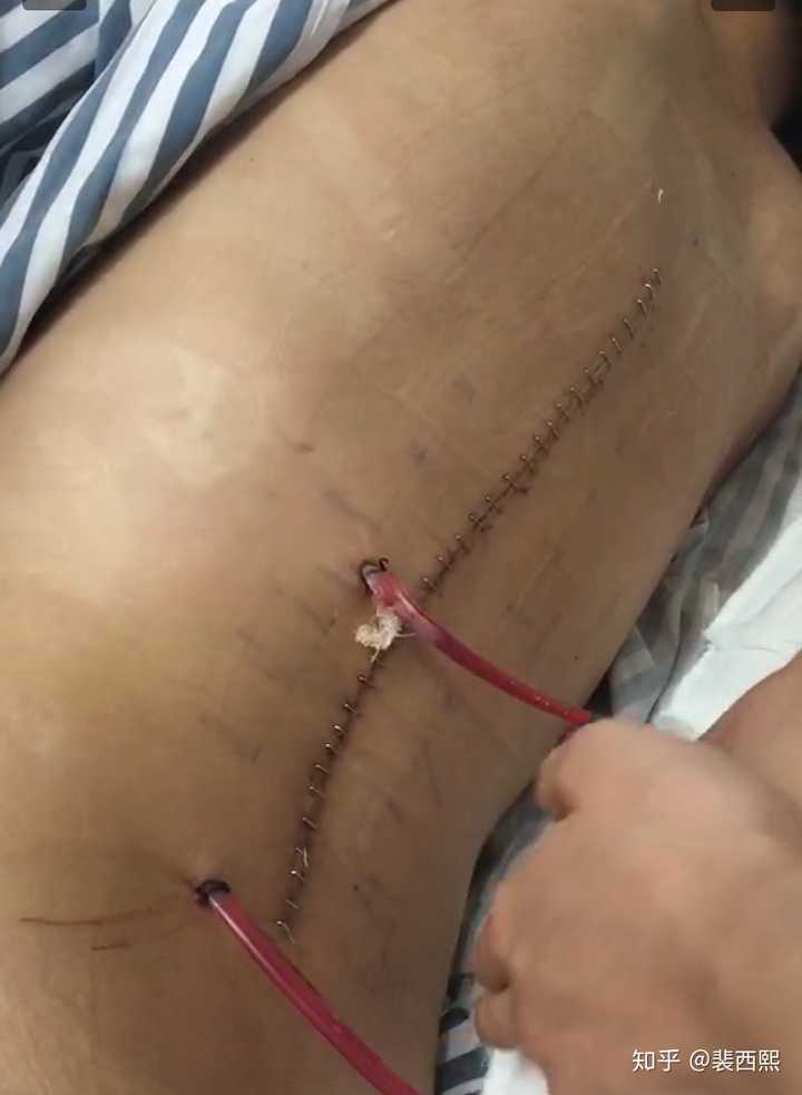 脊柱矫形术后很痛苦,是那种吊着止痛针,在屁股打止痛针,在静脉通道推