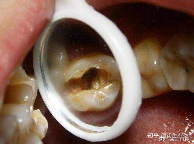 得了龋齿,如何自我判断严重程度?