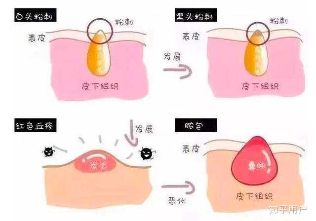如何去除鼻子上的黑头?
