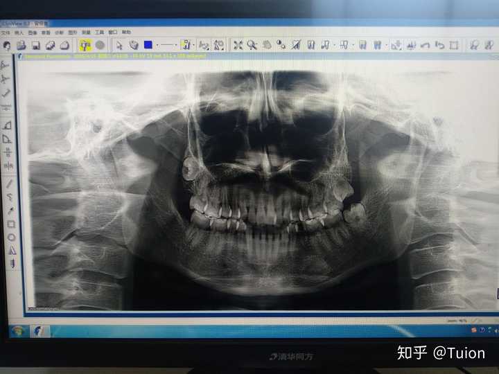 全景片(有一颗蛀牙,完全黑了)