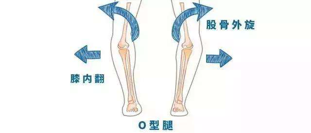 如何矫正罗圈腿(o型腿?