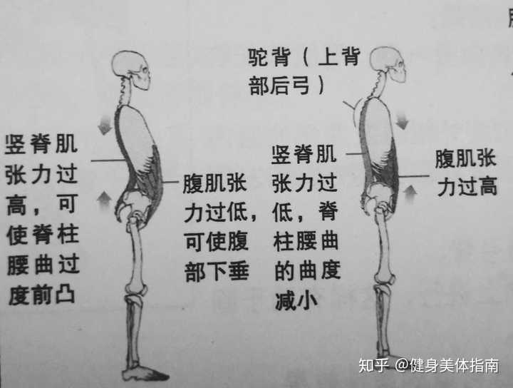 腹部肌肉与背部肌肉的功能平衡 驼背(上背部后弓),脊柱腰曲消失,可以