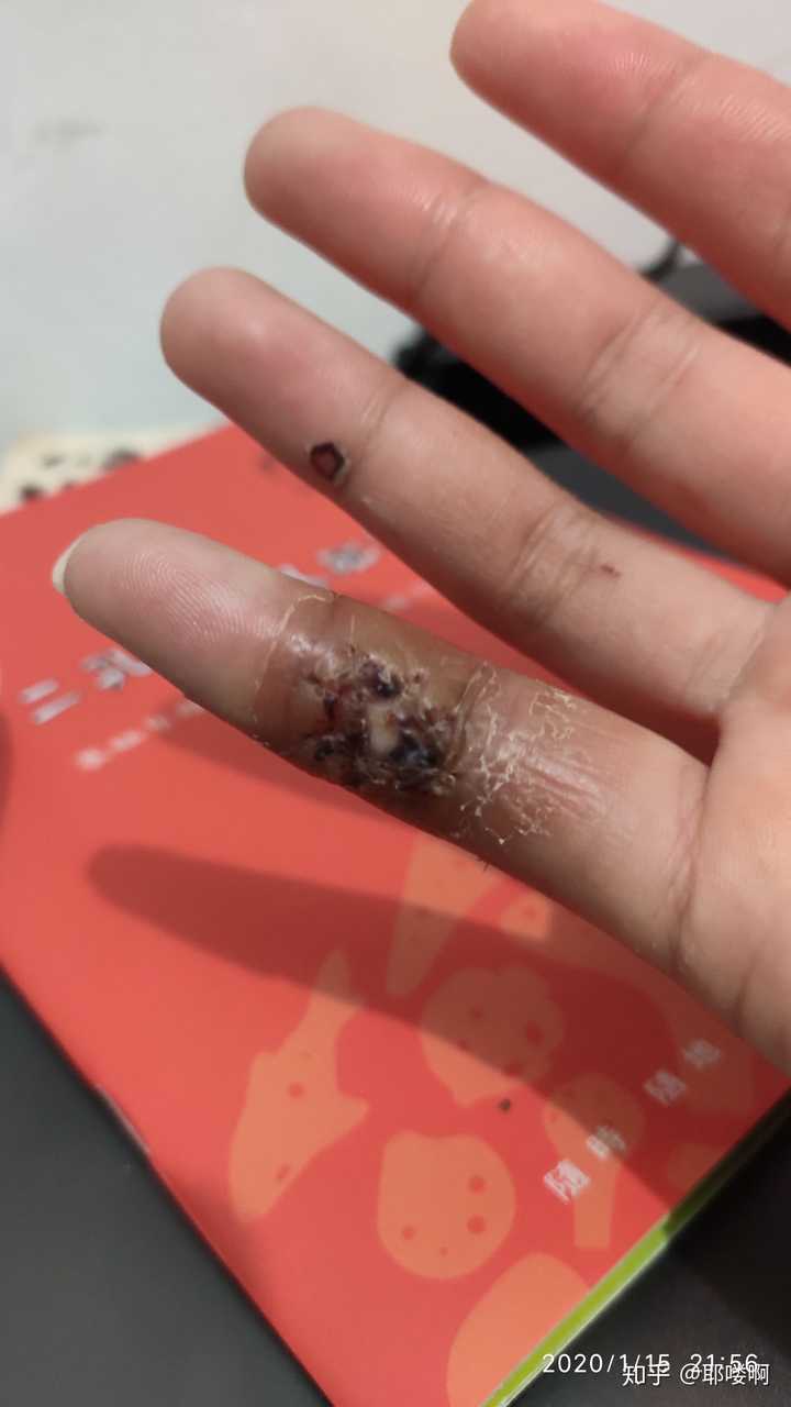 拆线的医生虽然没说什么,但是我看这这伤口我心里都觉得要去植皮了
