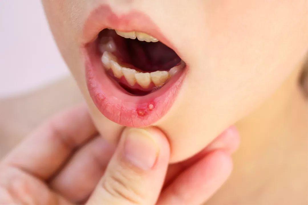 六岁的小孩经常口腔溃疡有什么办法吗
