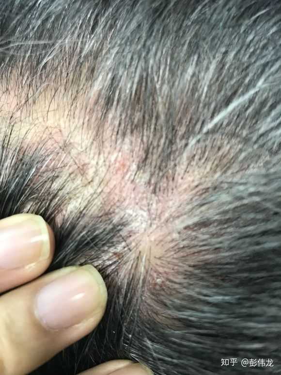 头皮毛囊炎怎么治疗