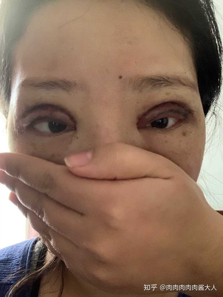 全切双眼皮手术恢复记录?