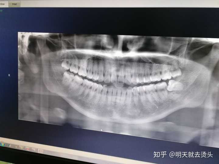 智齿一定要拔掉吗
