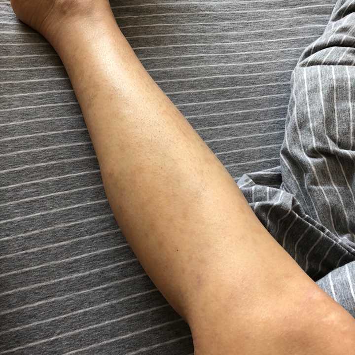 在这说一下自己的经历 em…因为我知道银屑病也就是俗说的牛皮癣真