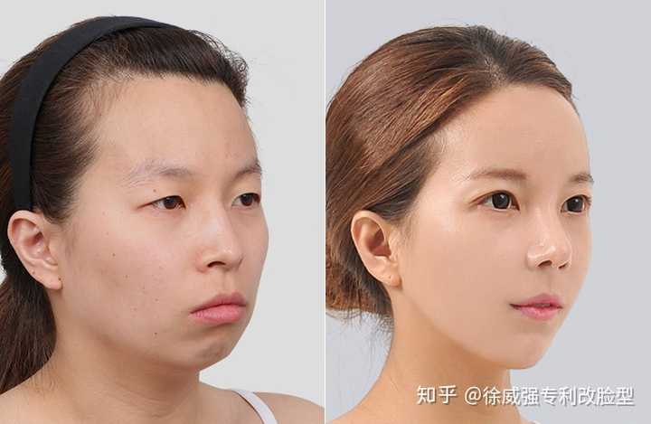 对于女生来说,脸型和五官哪个更重要?有哪些改善脸型的方法?