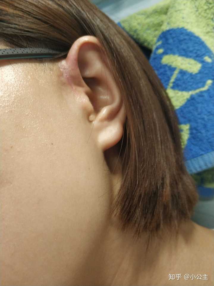 患有先天性耳前瘘管是一种怎样的体验?