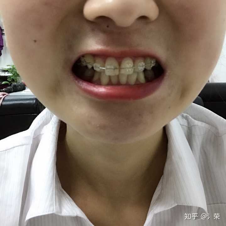 20岁的女生,矫正牙齿戴牙套,还要拔四颗牙是什么感觉啊,担心会不会有