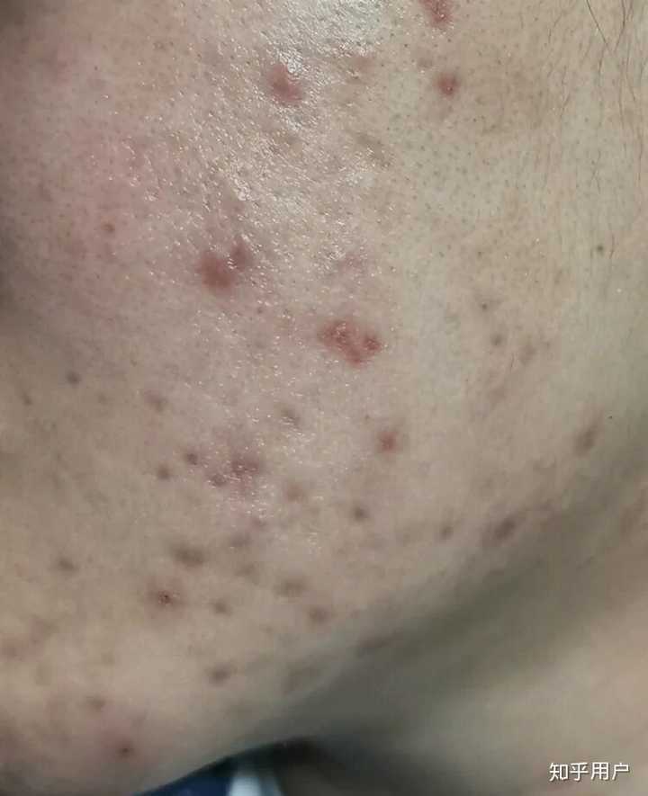 这时候在抗炎根本没有效果的,只能通过淡化黑色素的方法来淡化痘印