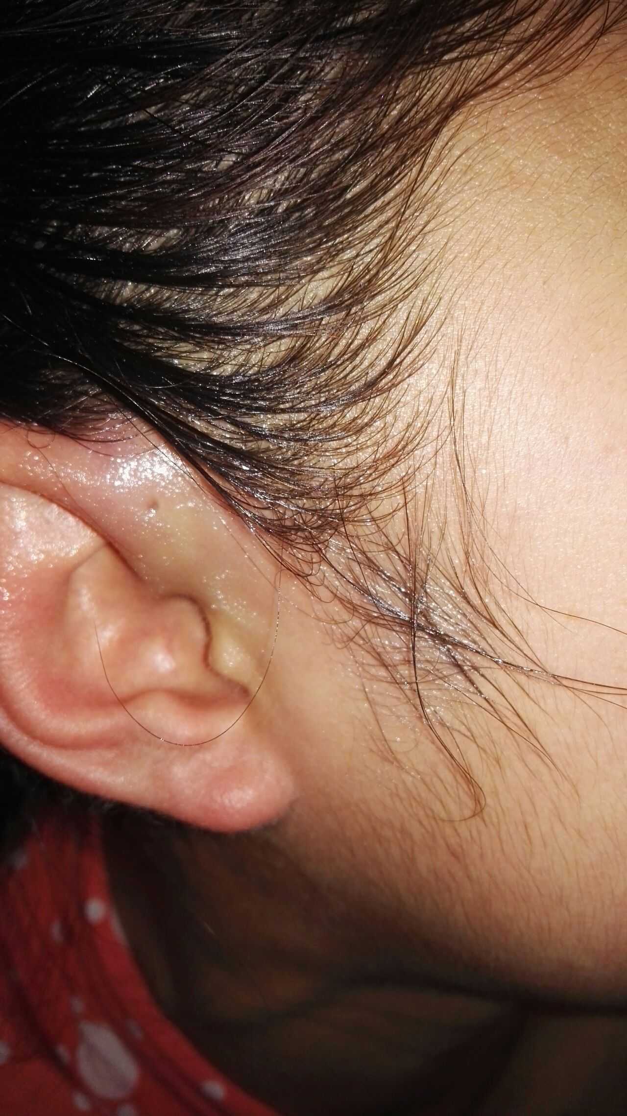 校医院的医生好年轻(可能是学长不是正规医生……)他说我是毛囊炎