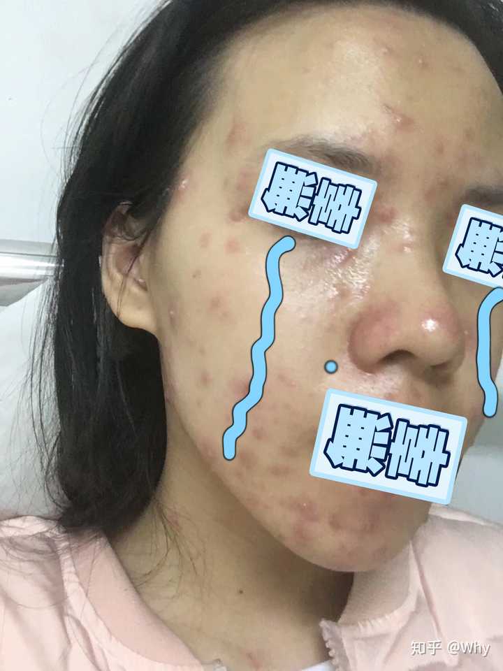 成人长水痘是什么样的经历?