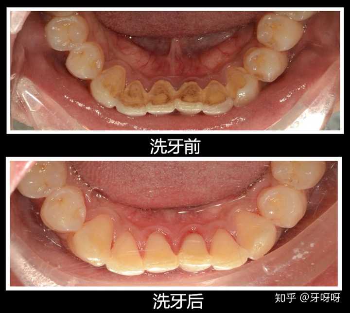 第一次洗牙有什么需要注意的吗?