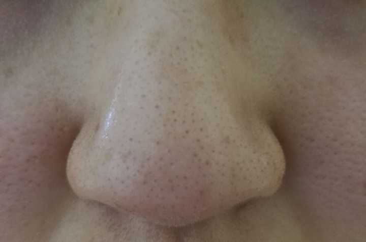 如何去除鼻子上的黑头?
