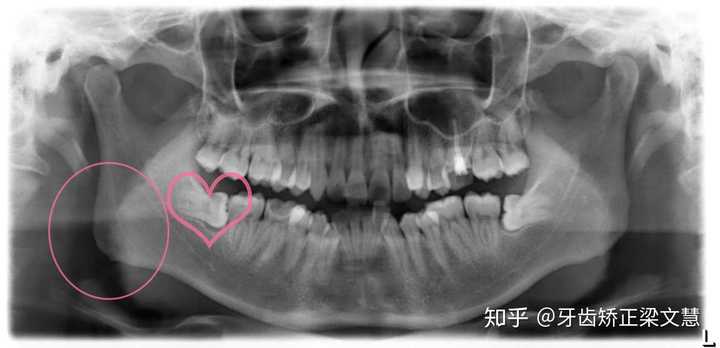 下颌角与智齿,智齿长在牙槽骨,离下颌角有一定距离
