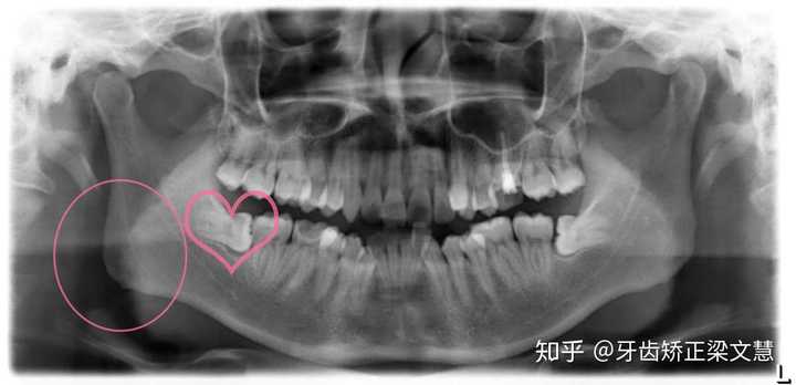 拔完智齿脸会小吗?