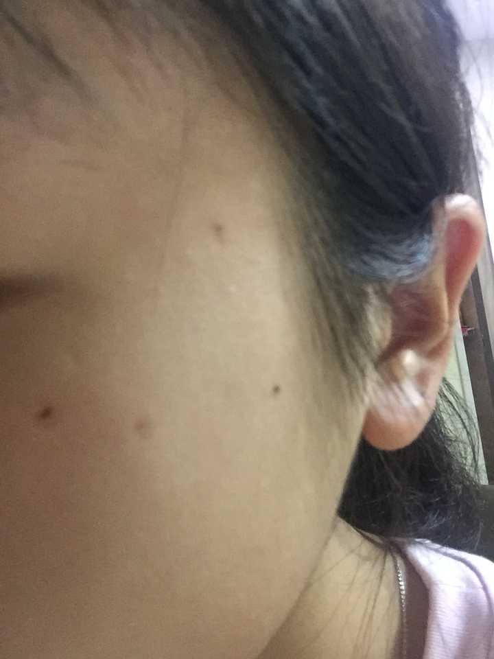 脸上一直长痣是怎么回事?