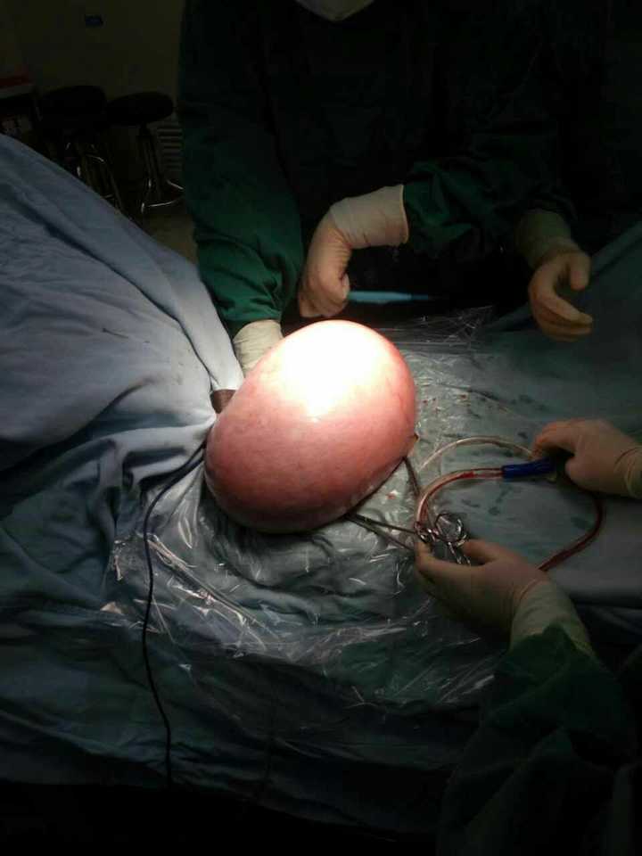 25kg的子宫肌瘤,包膜超级完整,瘤子超级漂亮,切开可见牛肉样变.