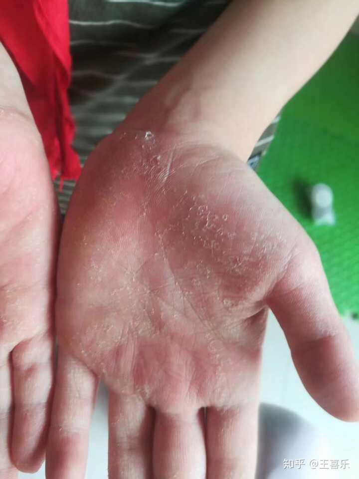 小朋友手掌真菌感染脱皮严重,给建议使用了了阁的青玉案洗颜泥洗手