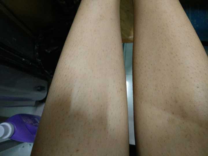 女生怎么脱毛最合适?