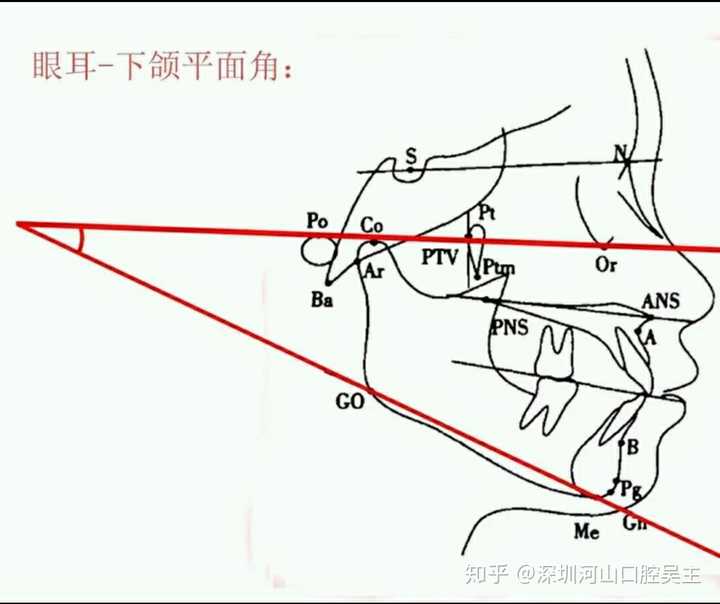 低角面型为什么不适合拔牙?