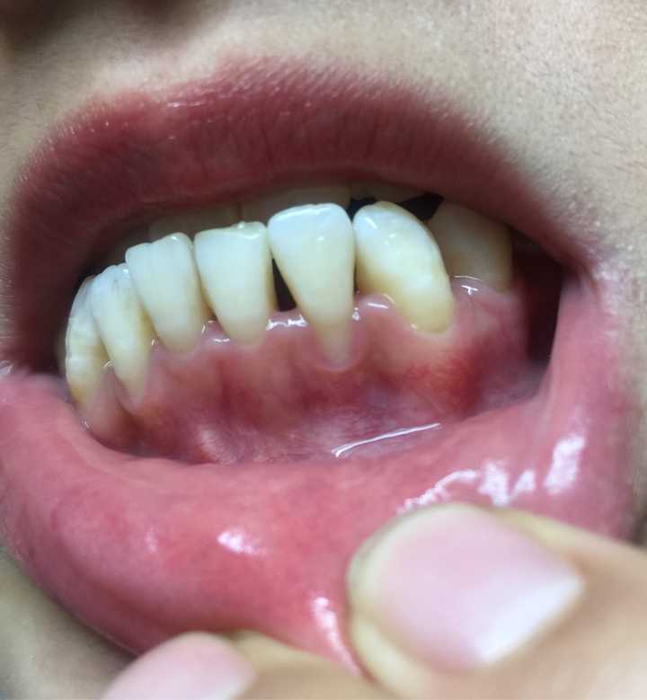 牙龈萎缩适合做牙齿正畸吗?