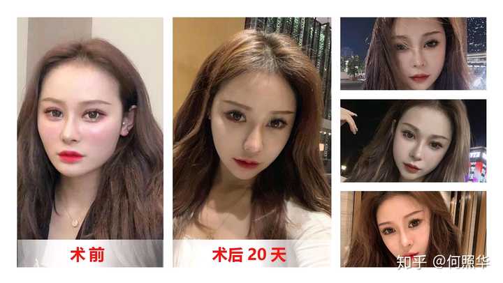颧骨内推和下颌角可以一起做吗,会有生命危险和后遗症吗?
