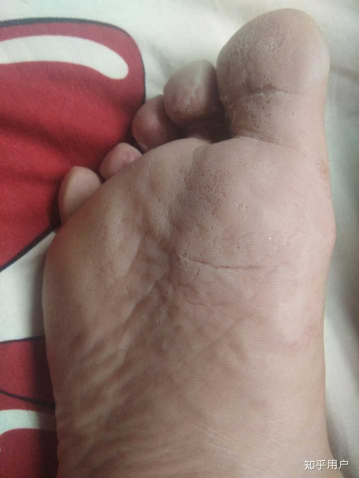水泡型脚气和汗疱疹的区别