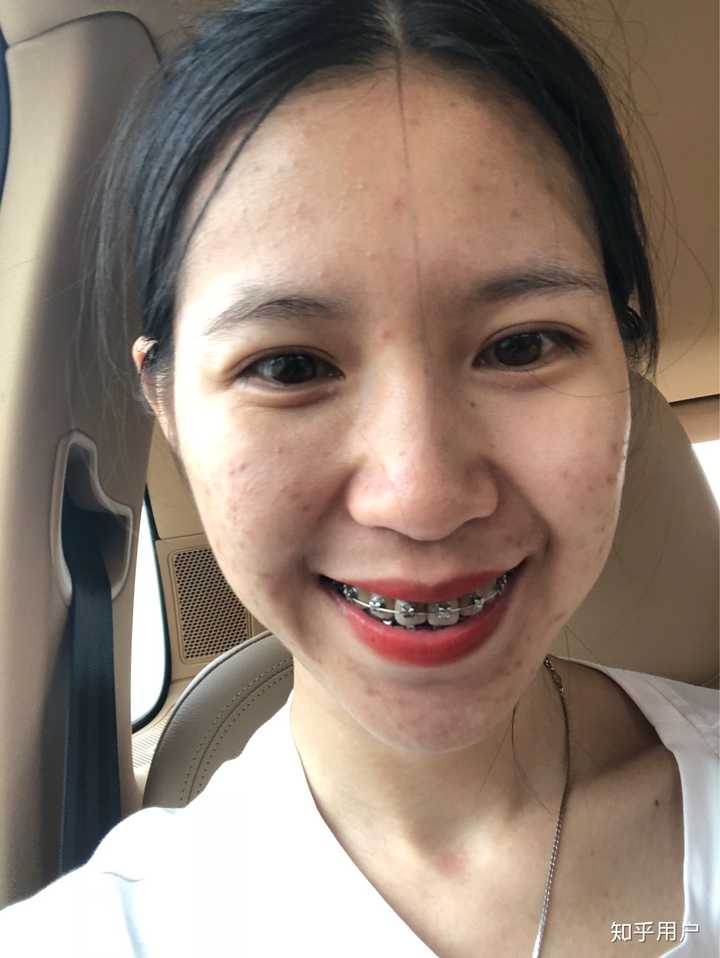 做过牙齿正畸的同学们,你们的脸型变了吗?