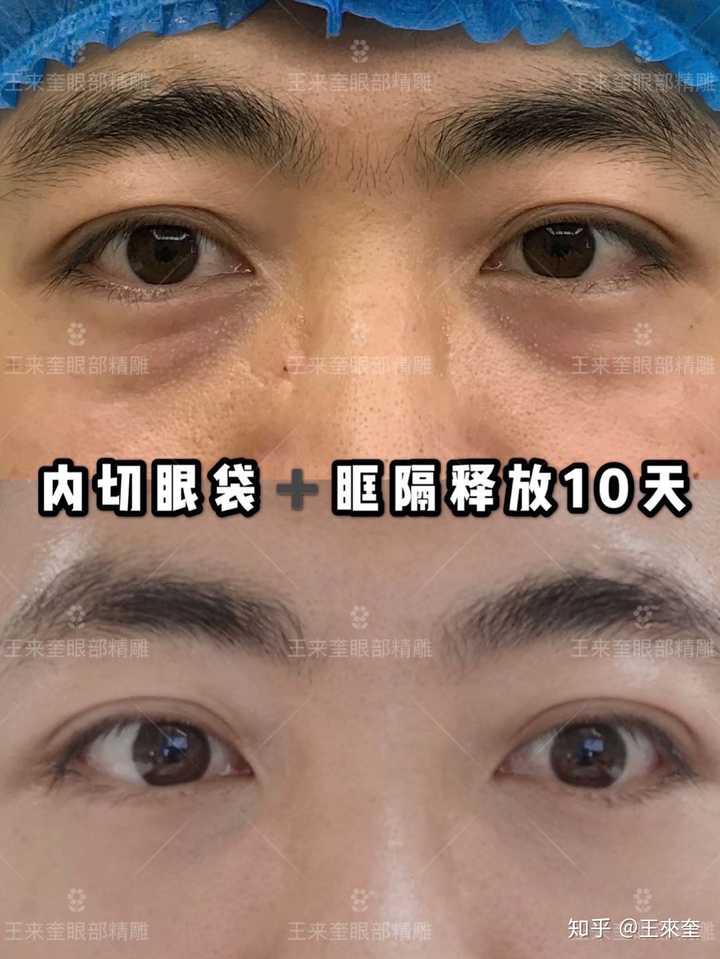 你可以参考下这位男士做的内切眼袋 眶隔释放手术.