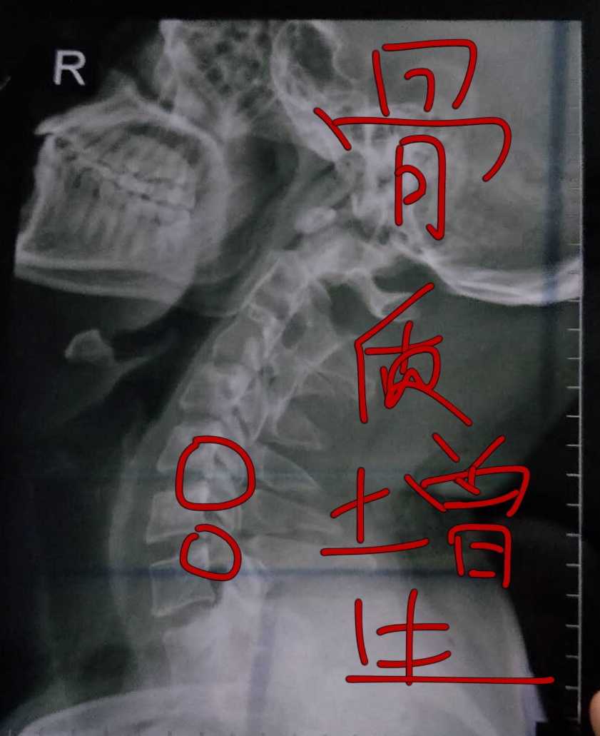 因为工作缘故导致骨质增生,椎间孔狭窄挤压了脊神经根,所以出现上肢