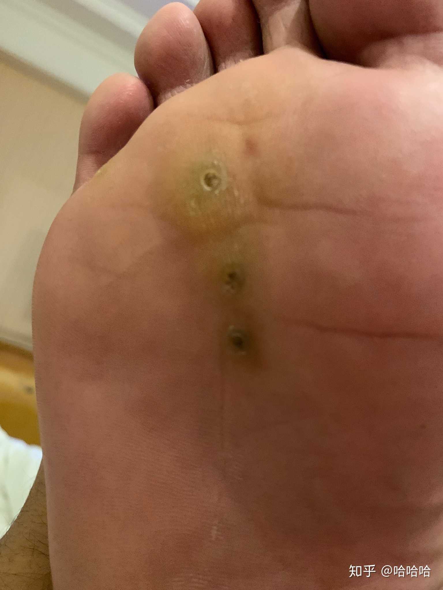 这是鸡眼还是跖疣啊!好烦!求教!