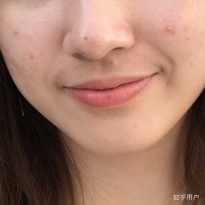 男生是不是不会喜欢脸上有痘印或痘痘的女孩子啊?