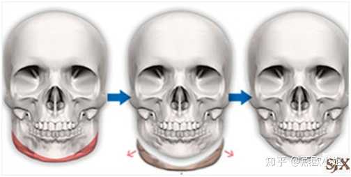图片来源网络,侵删 而面部削骨就是把下颌角多余的骨头切除,达到"瘦脸