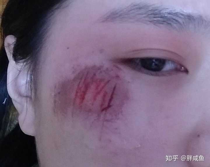 当天晚上,距事发大概五六个小时后,伤口颜色变得很深了