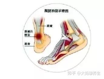 劳损,充血,从而出现无菌性炎症,导致脚后跟疼痛