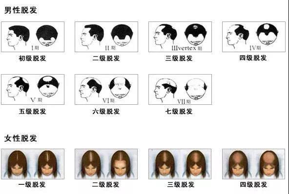 男,女性脱发的不同等级对比