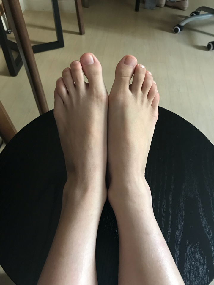 作为一个女生,脚拇指外翻是一种怎样的体验?