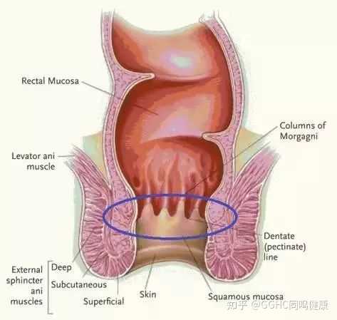 当痔疮发生在齿状线以上的时候叫内痔,发生在齿状线以下的叫外痔,同时