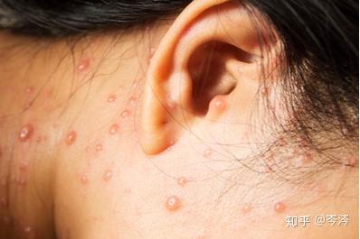 「水痘」发病原因是什么,出水痘有哪些症状,如何护理?