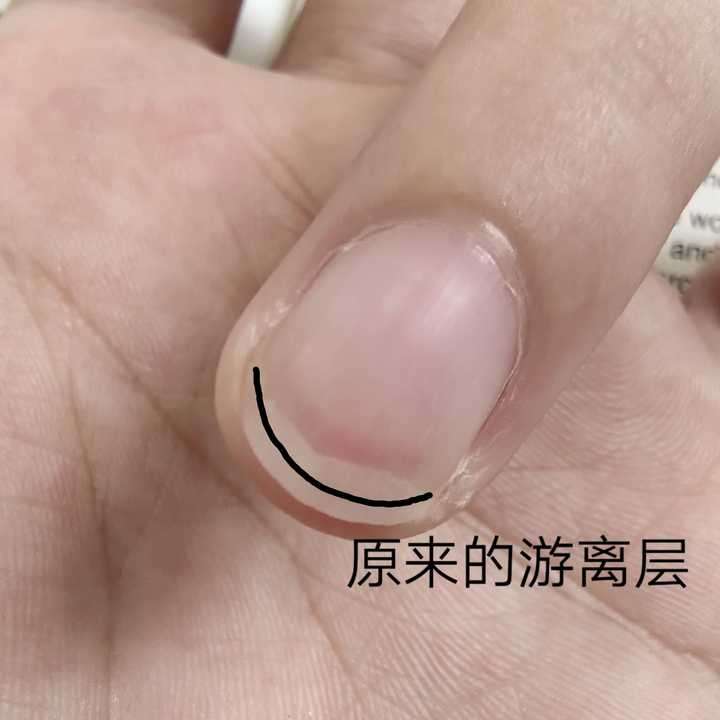 但是我有个指甲的游离层由半圆形变成快一条直线了我好不喜欢555