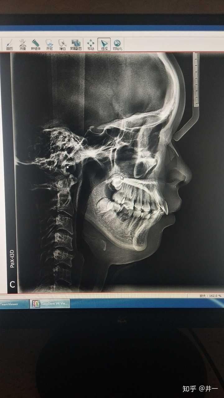 侧位片可以看出来我牙齿深覆合,然后下巴是有点骨性后缩,下巴后缩